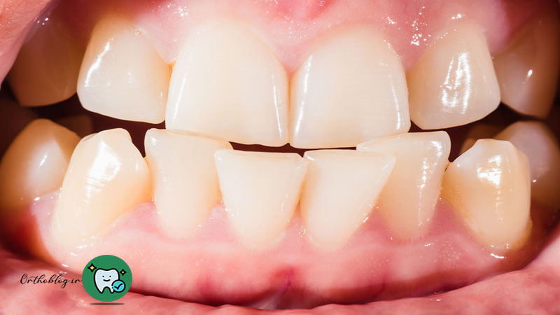 میزان ناهنجاری دندان ها 
