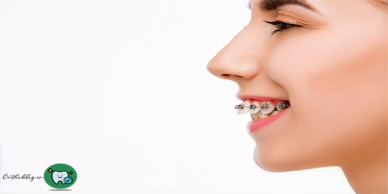 دیپ بایت متخصص ارتودنسی