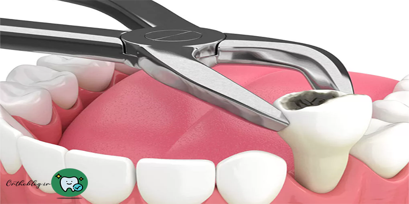 نکشیدن دندان در ارتودنسی مدرن