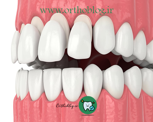 هزینه لمینت دندان درسال 1401