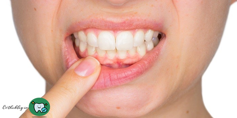 درد لثه هنگام نخ دندان