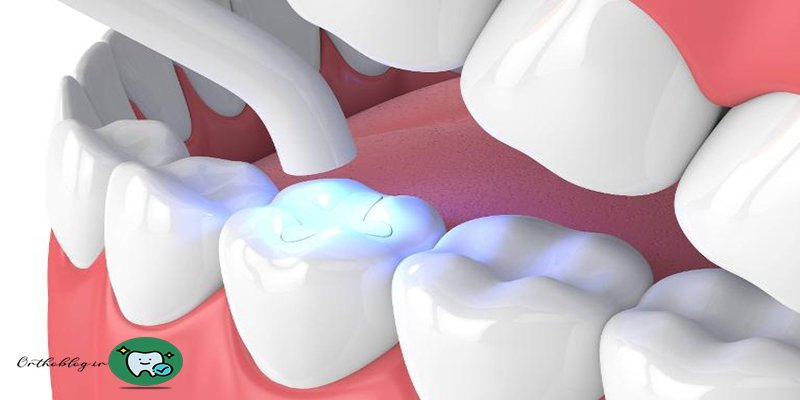موارد استفاده از کامپوزیت دندان