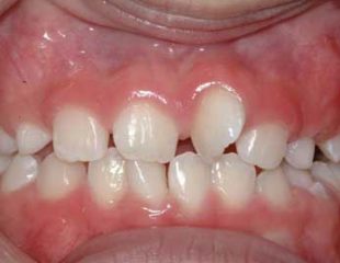ارتودنسی دندان کج
