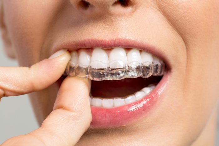 ارتودنسی اینویزیلاین
