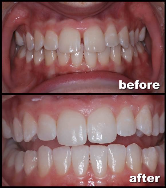 ارتودنسی دندان قبل و بعد