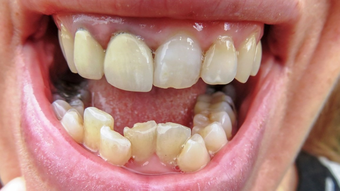 ارتودنسی عقب بردن دندان