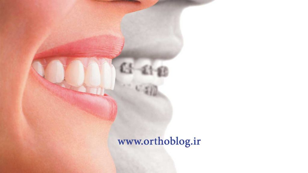 تفاوت ارتودنسی اینویزیلاین و ارتودنسی ثابت