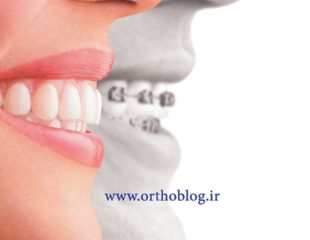 تفاوت ارتودنسی اینویزیلاین و ارتودنسی ثابت