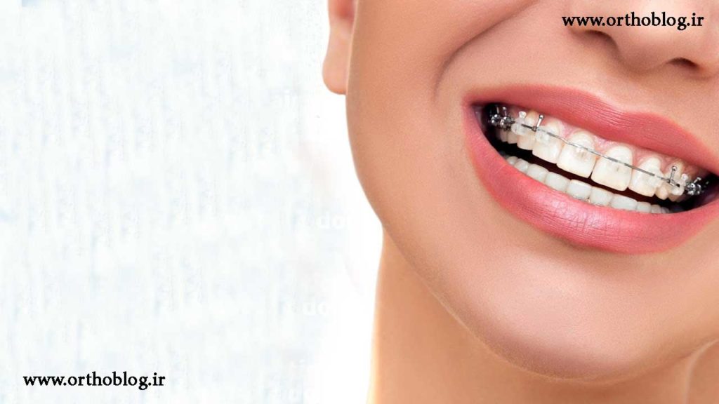 ارتودنسی دندان برای طرح لبخند