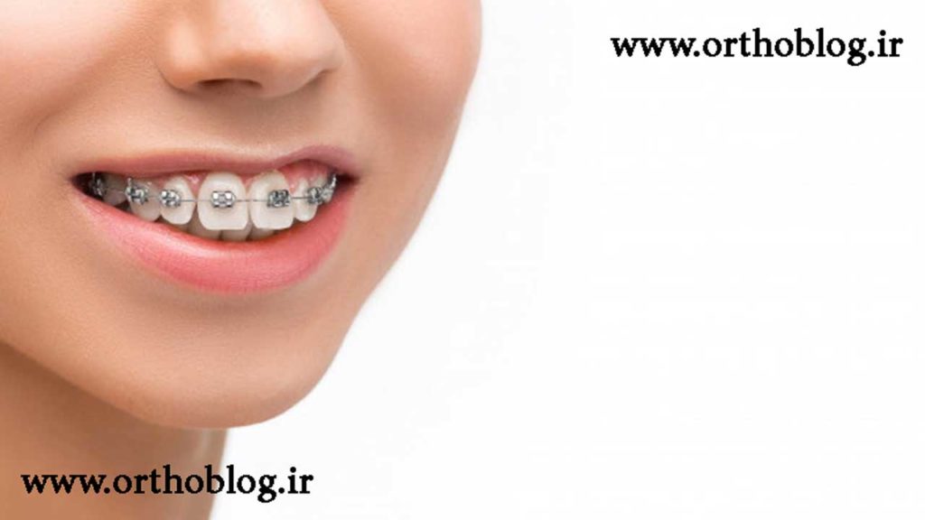 ارتودنسی طرح لبخند
