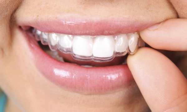 ارتودنسی دندان ژله ای