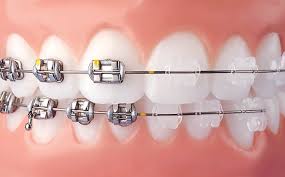 ارتودنسی دندان چند مرحله دارد-2
