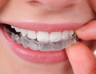 هزینه ارتودنسی ژله ای