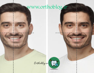 ارتودنسی صورت نامتقارن
