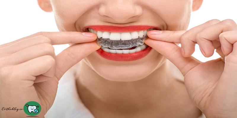 ارتودنسی متحرک بهتره یا ثابت