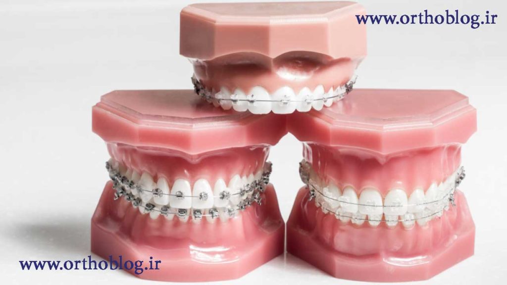 انواعی از بریس های ارتودنسی