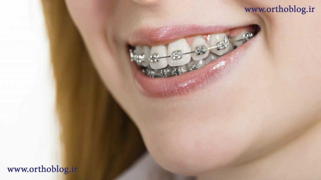 نتیجه ارتودنسی