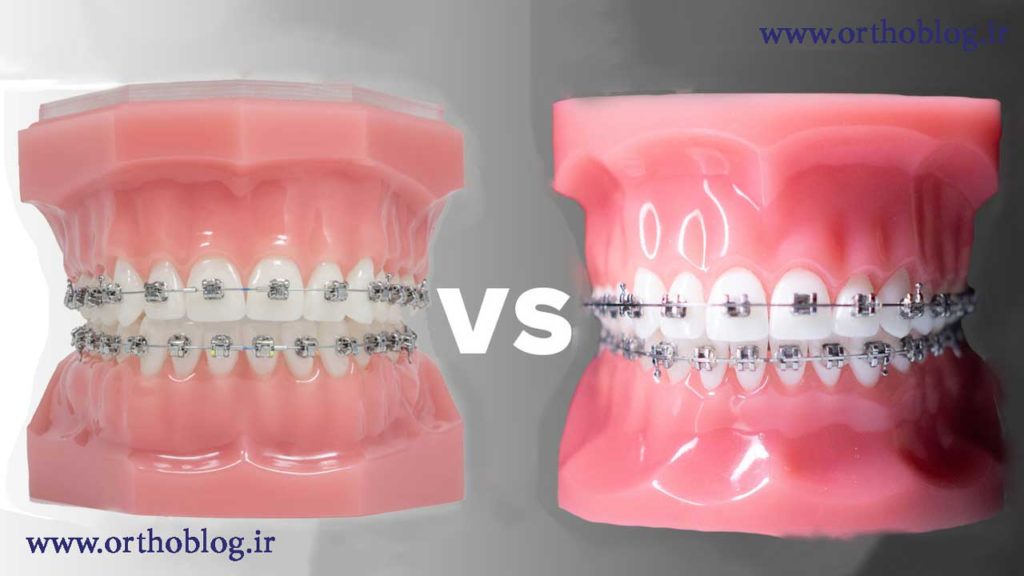 بریس های ارتودسنی