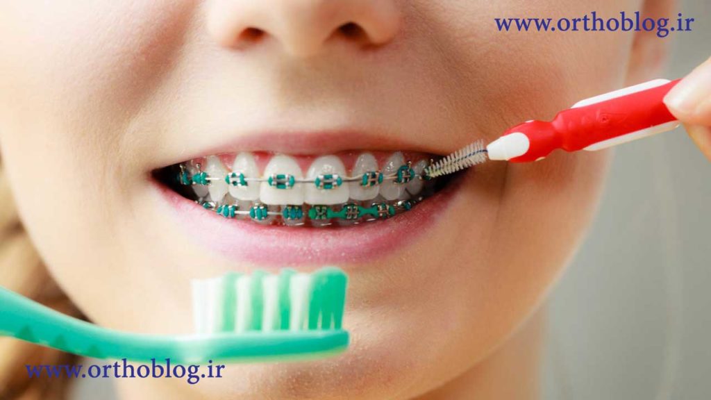 انجام ارتودنسی دندان برای یک کودک