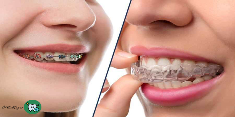 ارتودنسی متحرک یا ثابت
