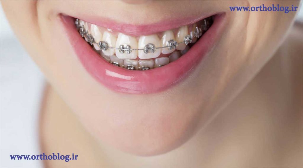نتیجه ارتودنسی دندان