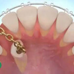ارتودنسی تک دندان