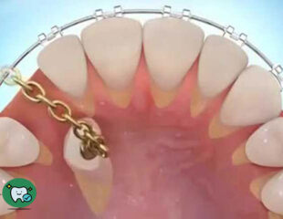ارتودنسی تک دندان