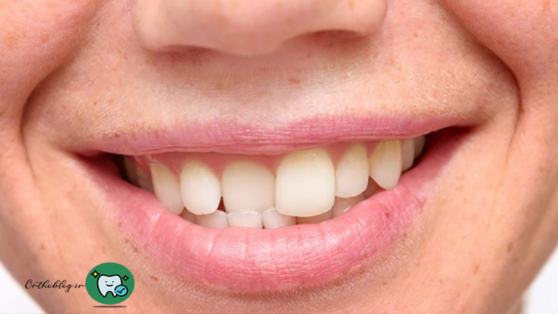 نکات مهم در ارتودنسی تک دندان