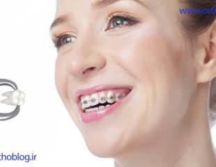 ارتودنسی همراه با کشیدن دندان