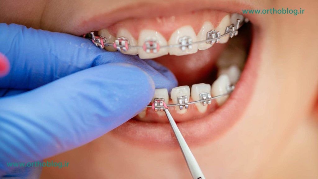 ارتودنسی دندان 