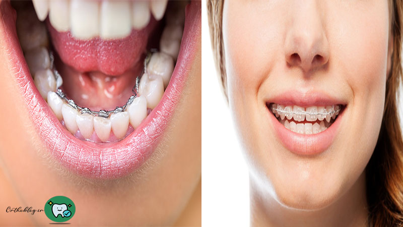 ارتودنسی لینگوال یا پشت دندانی