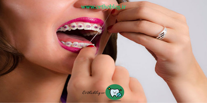 پوسیدگی دندان هنگام ارتودنسی
