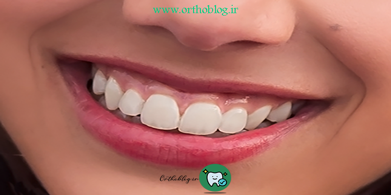 ارتودنسی لبخند لثه ای