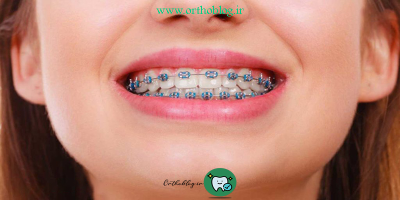 ارتودنسی ژنژیوکتومی