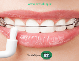 ارتودنسی ثابت دو فک با ریتینر