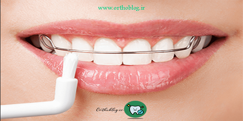 ارتودنسی ثابت دو فک با ریتینر