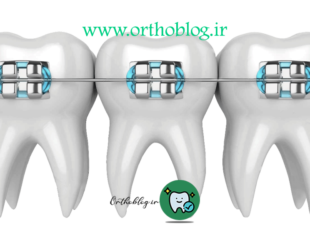 بریس ارتودنسی