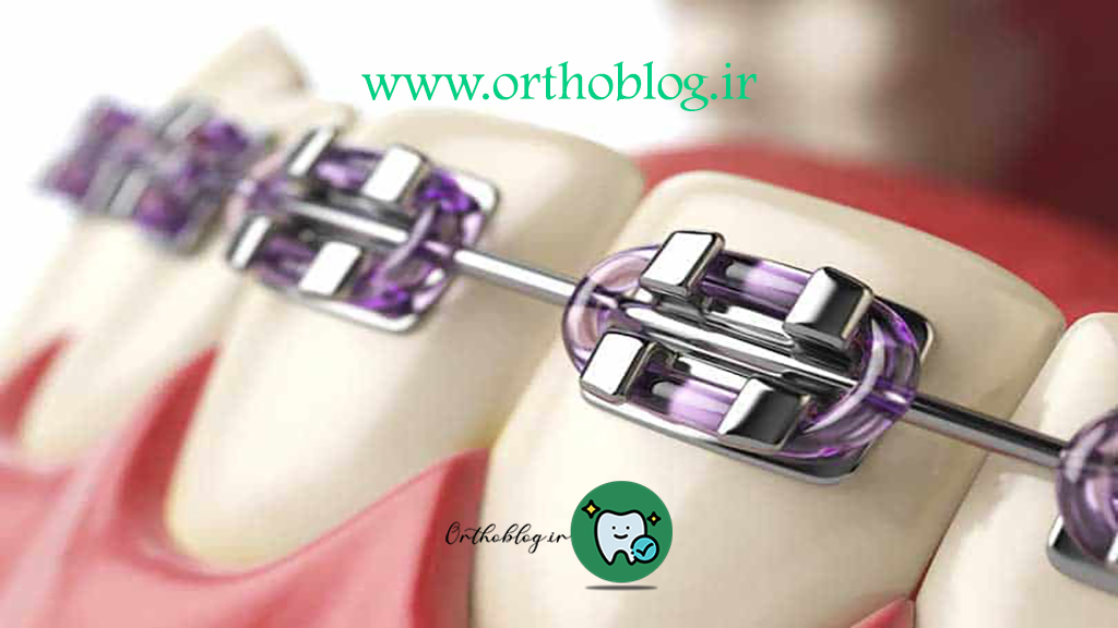 بریس های ارتودنسی