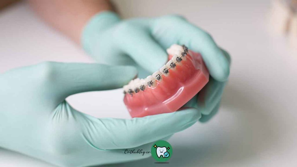 هزینه‌های ارتودنسی دندان شامل چه مواردی است؟