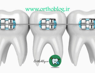 بریس ارتودنسی