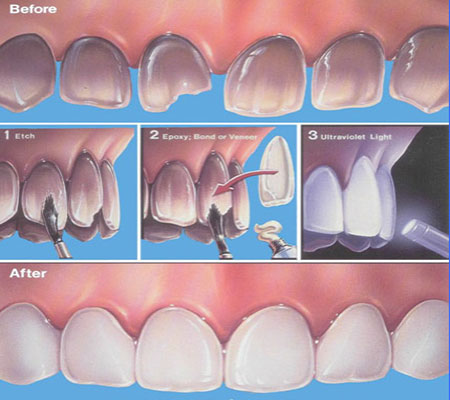 مراحل لمینت دندان با عکس