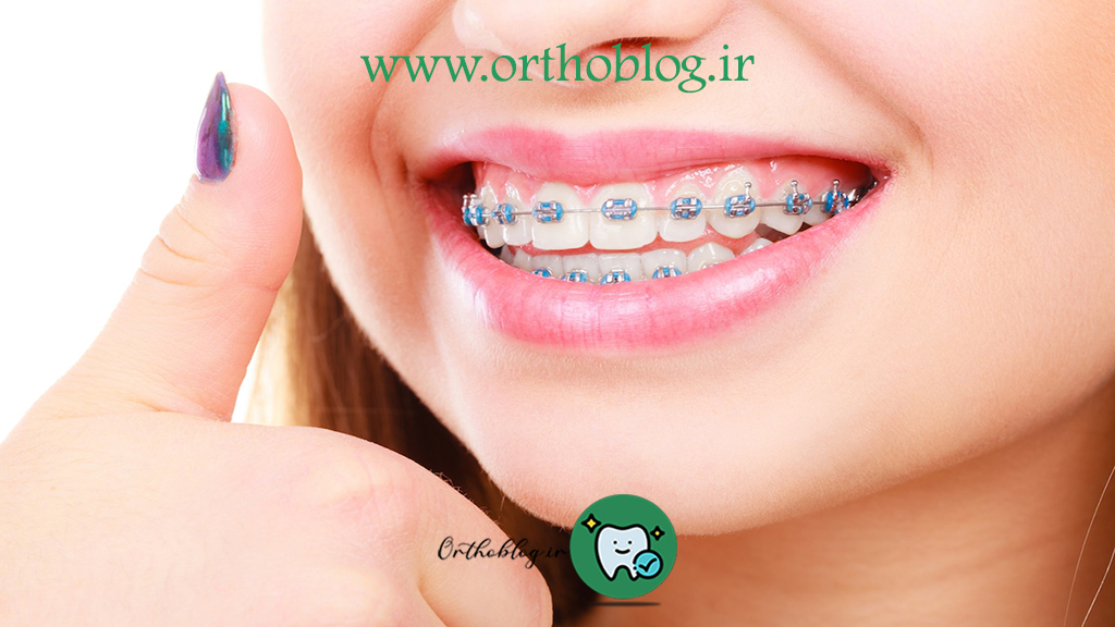 ارتودنسی و لمینت