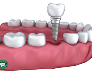 ایمپلنت دندان