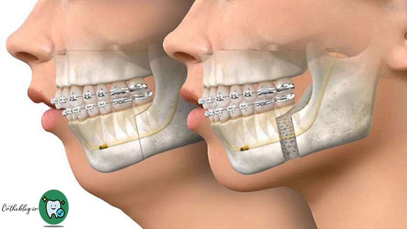 معایب و مشکلات عقب بودن فک پایین