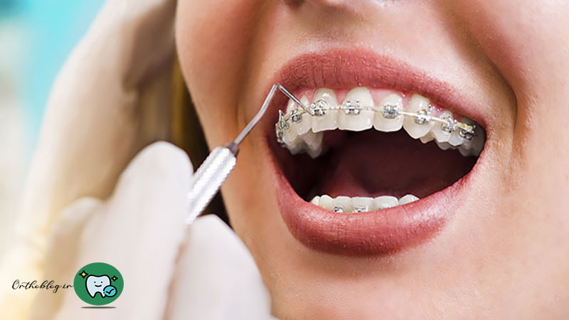 درمان اپن بایت دندان