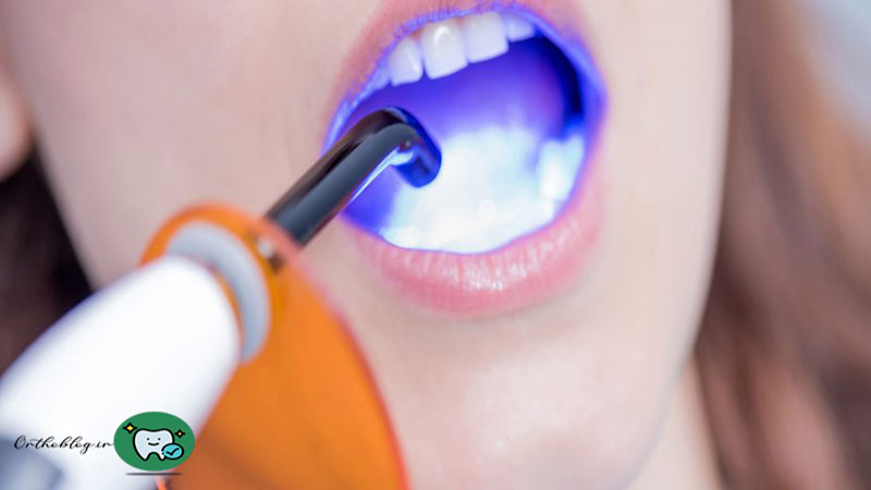 انواع کامپوزیت های دندان