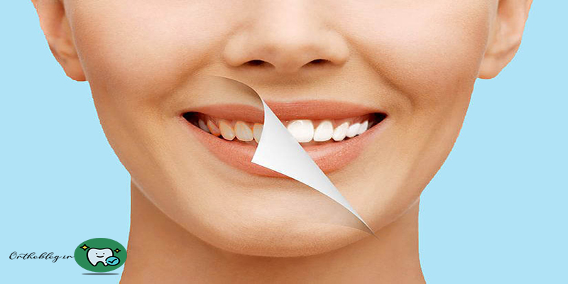 عوامل موثر در قیمت کامپوزیت دندان