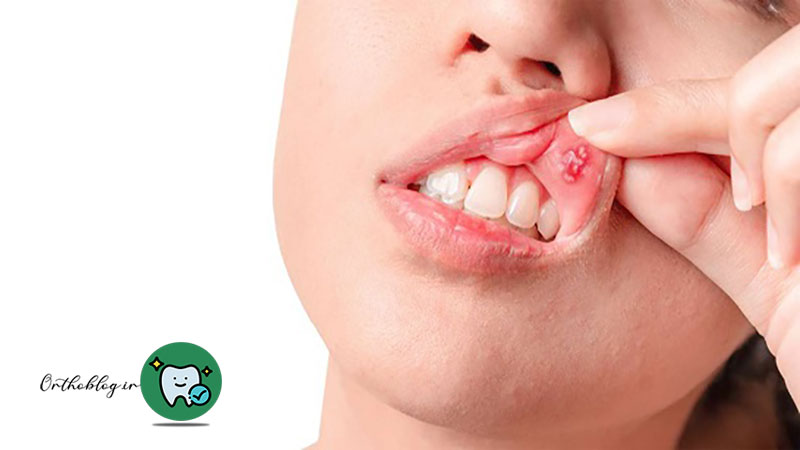 علت دقیق زخم‌های دهان