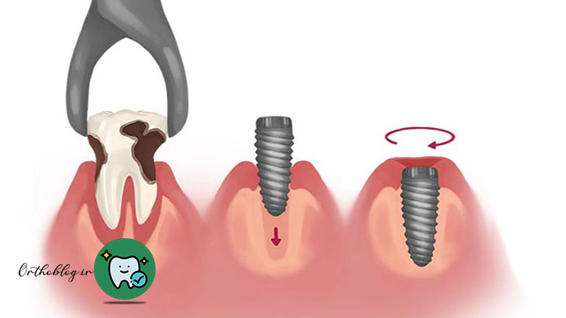 مراحل کاشت فوری دندان