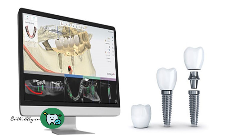 ایمپلنت دیجیتال چیست